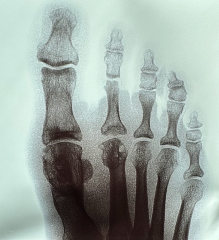 Xray of a foot